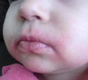 alergia a leite de vaca